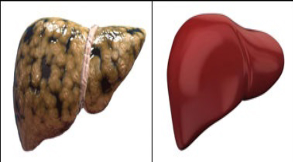 Fatty Liver: What is it and how to overcome it?